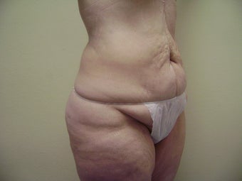 Tummy Tuck