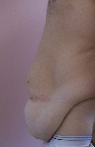 Tummy Tuck before and after
