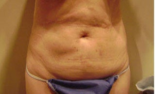Tummy Tuck