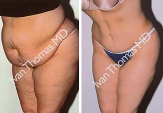 Tummy Tuck