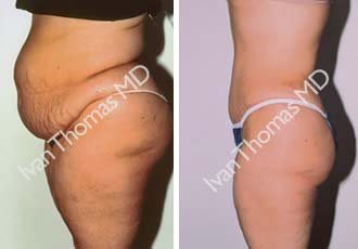 Tummy Tuck
