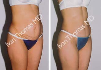 Tummy Tuck