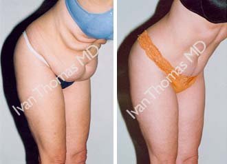 Tummy Tuck