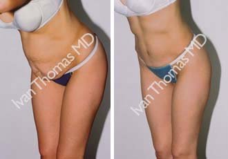 Tummy Tuck