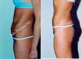 Tummy Tuck