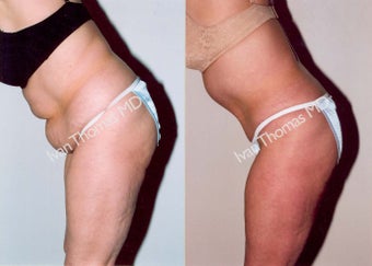 Tummy Tuck