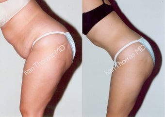 Tummy Tuck