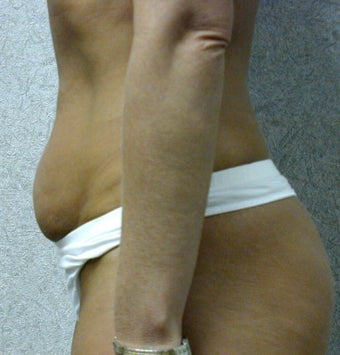 Mini abdominoplasty