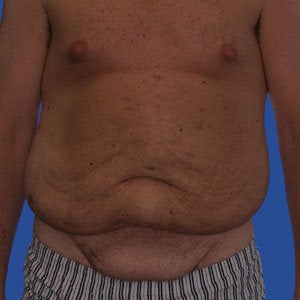 Abdominoplasty