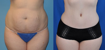 Tummy Tuck