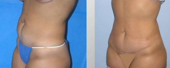 Tummy Tuck (Abdominoplasty)
