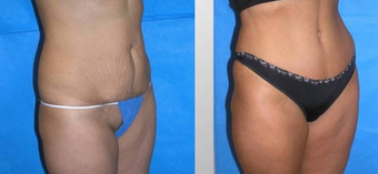 Tummy Tuck (Abdominoplasty)