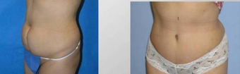 Tummy Tuck (Abdominoplasty)
