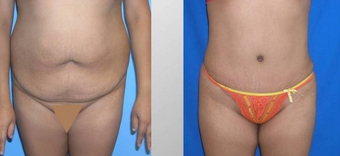 Tummy Tuck (Abdominoplasty)
