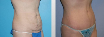 Tummy Tuck (Abdominoplasty)