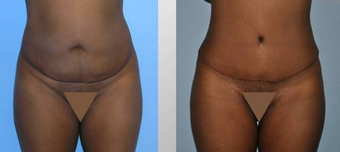 Tummy Tuck (Abdominoplasty)