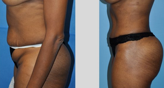 Tummy Tuck (Abdominoplasty)