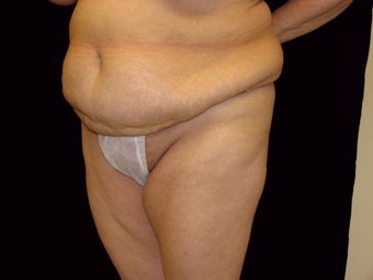 Abdominoplasty