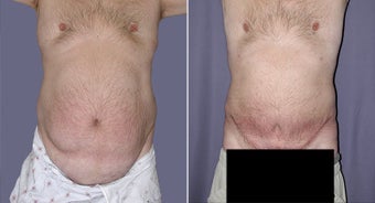 Tummy Tuck of a Male