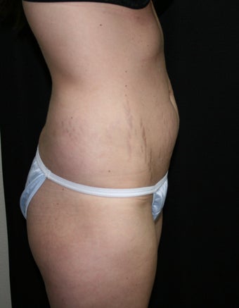 Abdominplasty (mini tummy tuck)