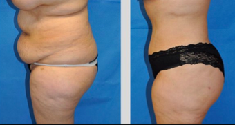 Tummy Tuck
