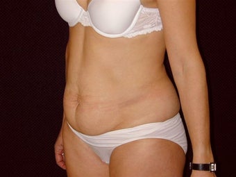 Tummy Tuck and Liposuction