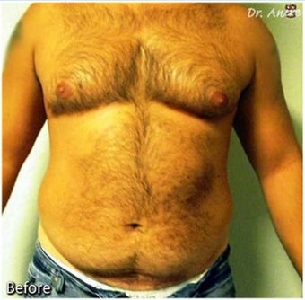 Male Liposuction of Abdomen and flanks