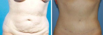 Abdominoplasty