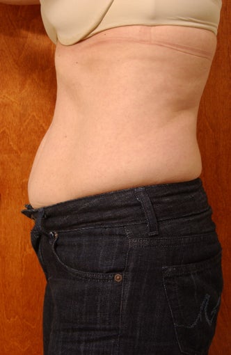Hybrid abdominoplasty