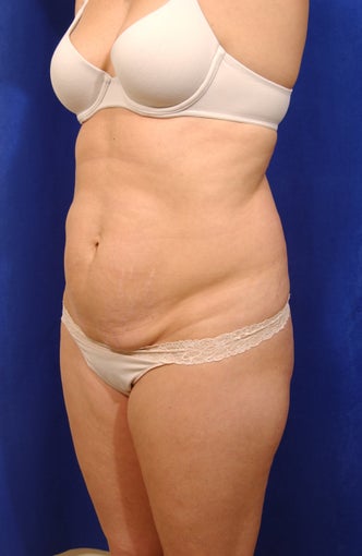 Abdominoplasty