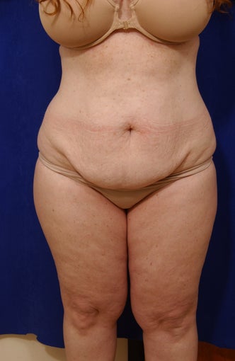 Abdominoplasty