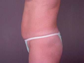 TUMMY TUCK 