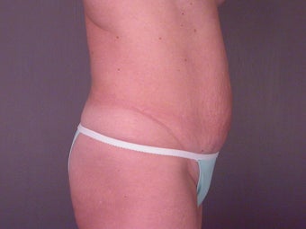 TUMMY TUCK 