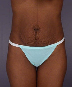 Tummy tuck