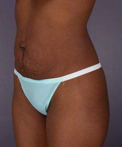 Tummy Tuck
