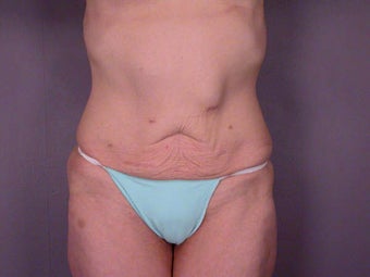 Tummy Tuck