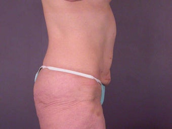 Tummy Tuck