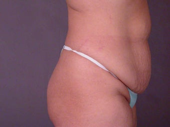 Tummy Tuck