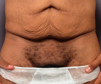 Male Body Contouring