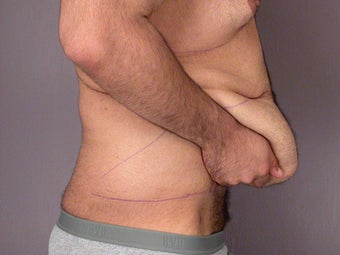 After Weight Loss Male Tummy Tuck