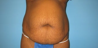 tummy tuck
