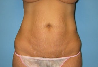 tummy tuck