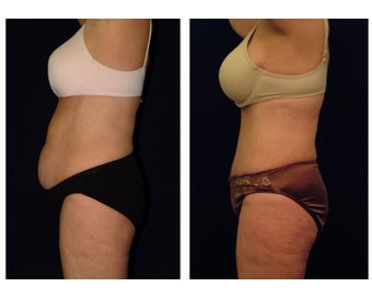 Tummy Tuck / Abdominoplasty