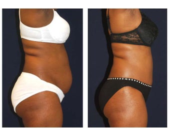 Tummy Tuck / Abdominoplasty