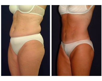 Tummy Tuck / Abdominoplasty