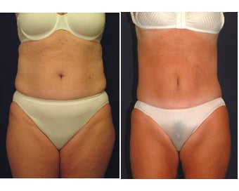 Tummy Tuck / Abdominoplasty