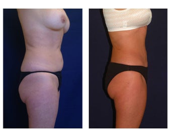 Tummy Tuck / Abdominoplasty