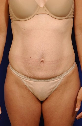 Abdominoplasty with liposculpture of abs and flanks