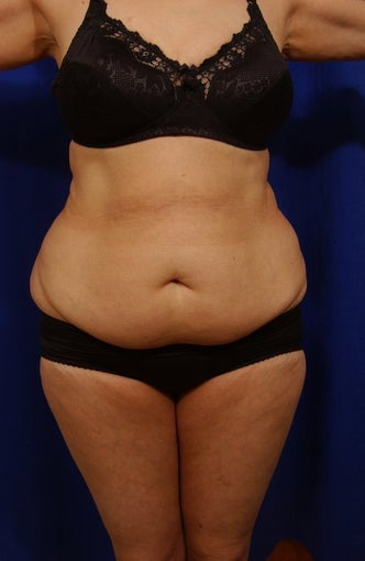 Abdominoplasty with liposculpture of abs, flanks