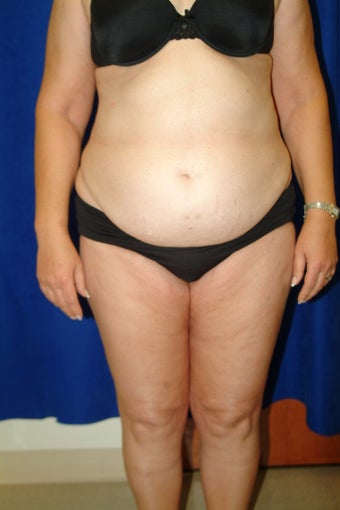 Abdominoplasty with liposculpture of abs, flanks, and waist